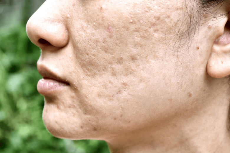 Are Pimple Scars Permanent? - Glopetra