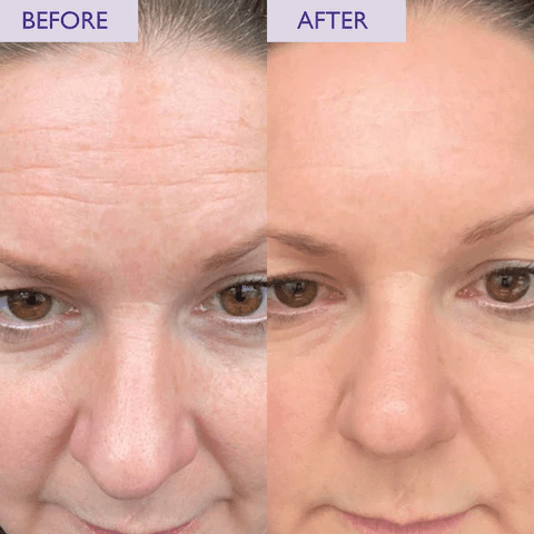 How Often Should You Apply Retinol for Best Results? - Glopetra