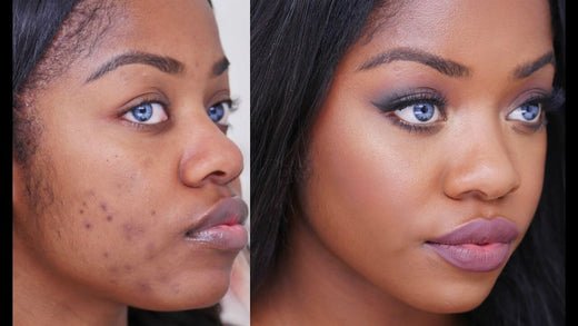 Serums for Treating Post-Acne Marks - Glopetra