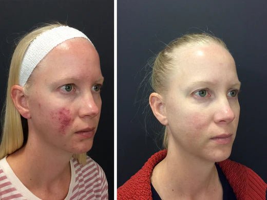 The Best Products for Treating Acne Scars in Winter vs. Summer - Glopetra