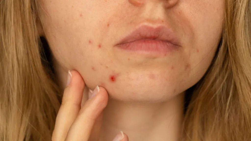 Tips for Using Vitamin C Serum on Acne-Prone Skin - Glopetra
