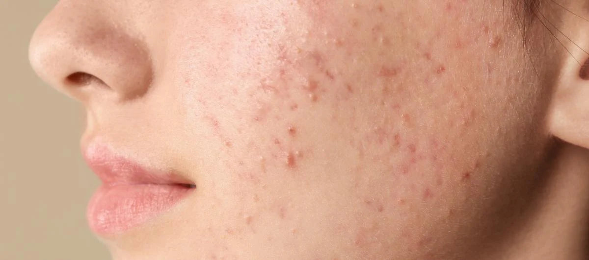 Niacinamide for Acne: How Effective Is It?