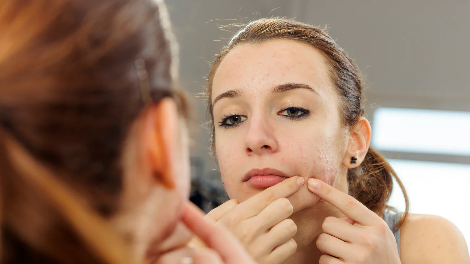 What skincare products get rid of acne scars