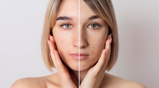 Comparing Retinol and Niacinamide for Hyperpigmentation - Glopetra