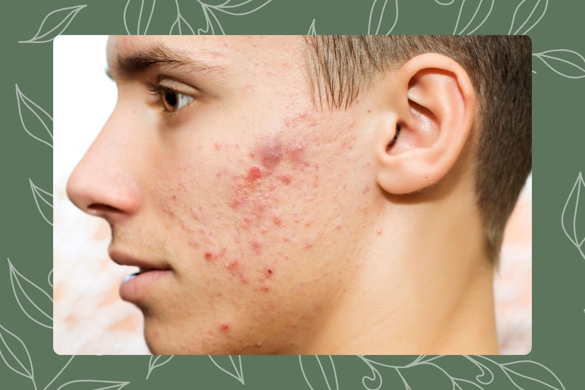 What Is Fungal Acne and How to Choose Products That Don’t Trigger It
