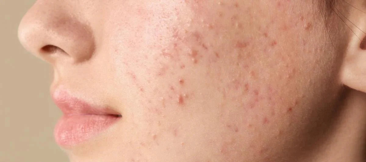 Niacinamide for Acne: How Effective Is It? - Glopetra