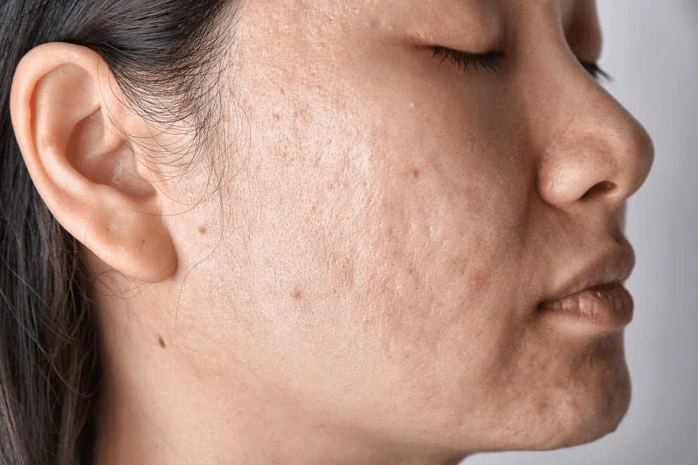 Top Acne Scars & Pits Removal Gel - Glopetra