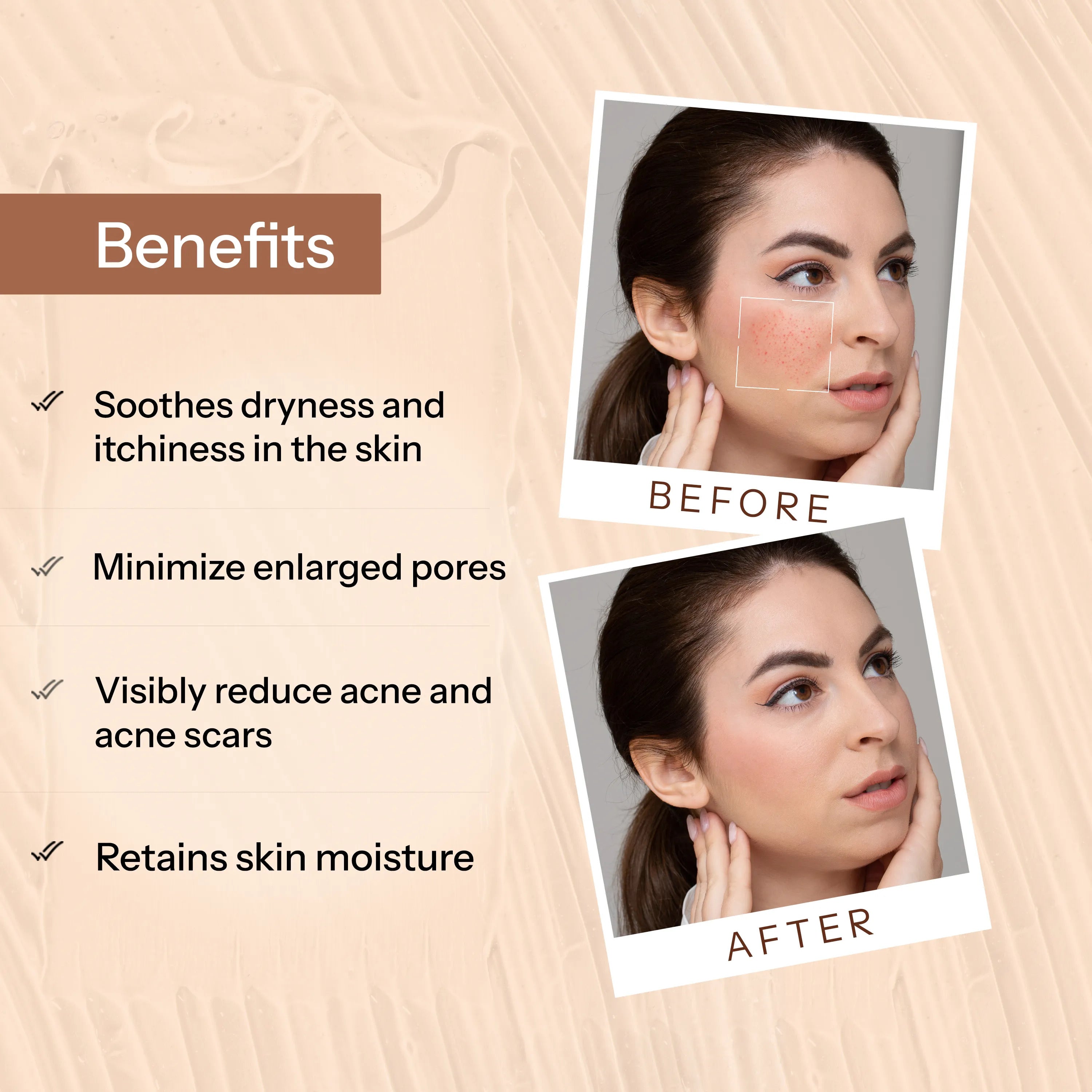 Glopetra Acne Care Combo